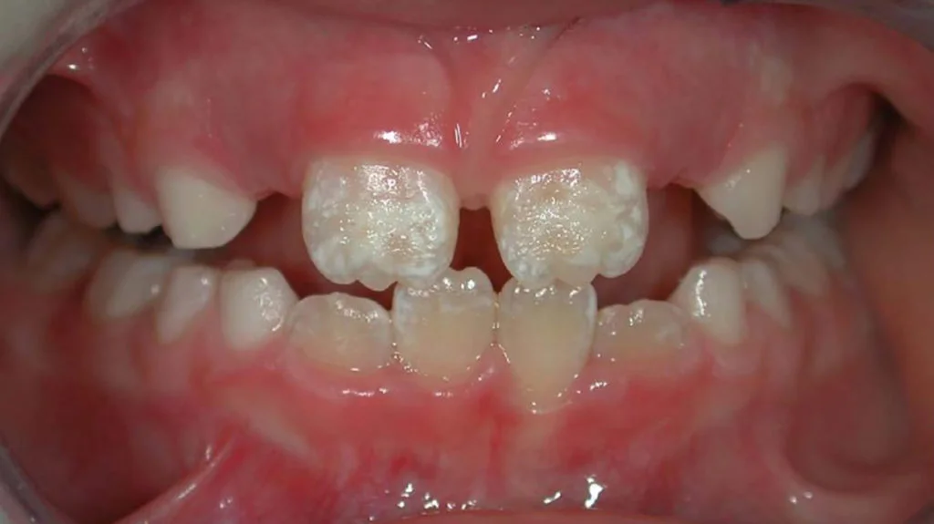 white spots on toddler teeth