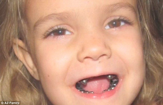 why do kids get silver teeth