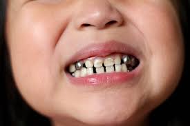 why do kids get silver teeth