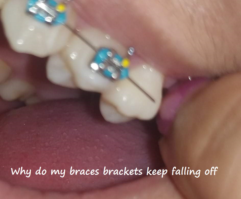 why do my braces brackets keep falling off