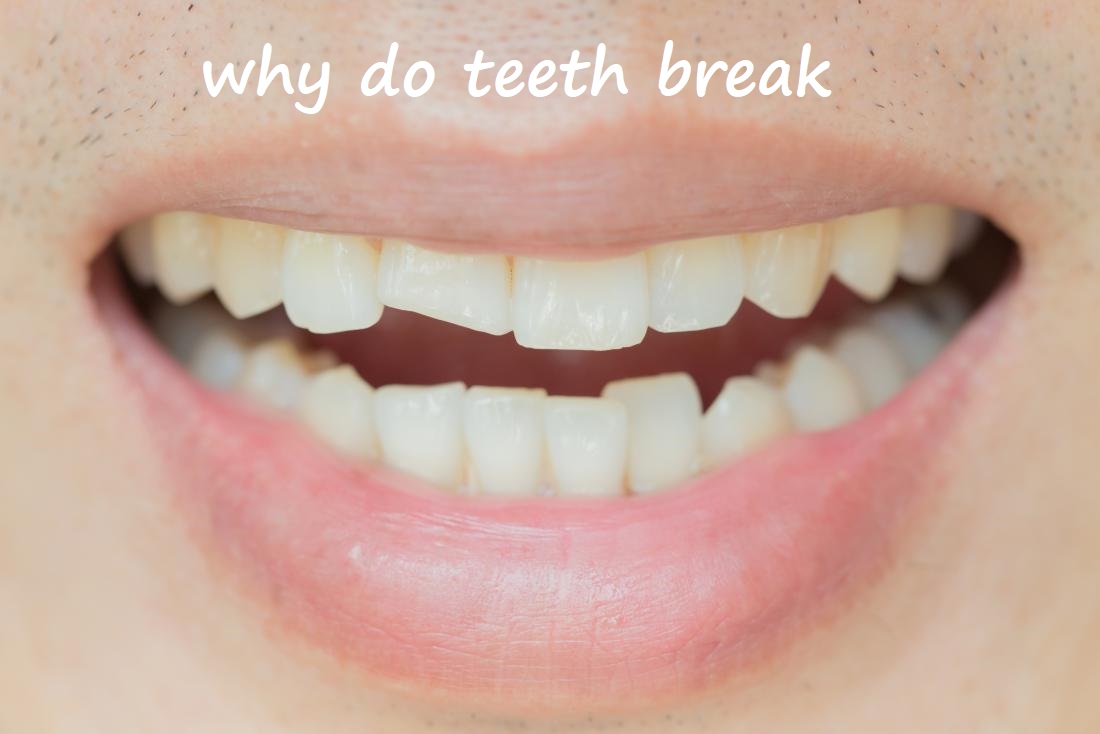 why do teeth break