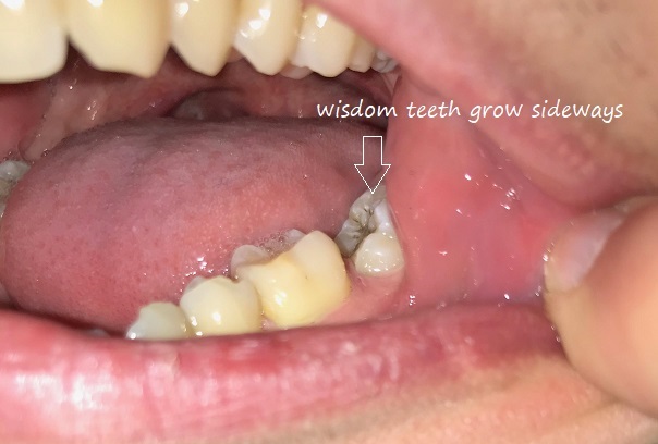 why do wisdom teeth grow sideways