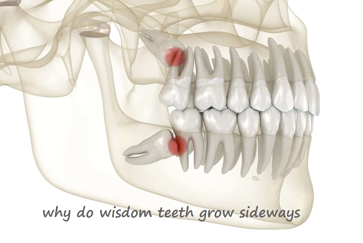 why do wisdom teeth grow sideways