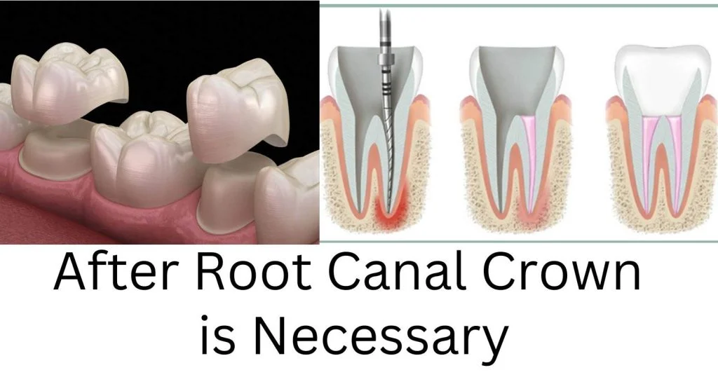 why wait two weeks after root canal for crown