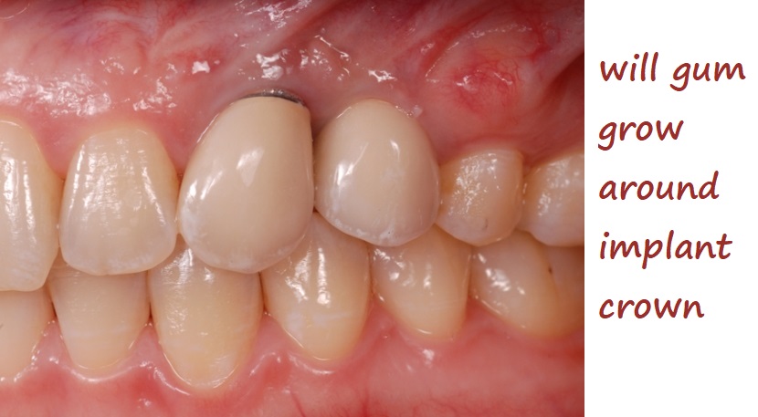 will gum grow around implant crown