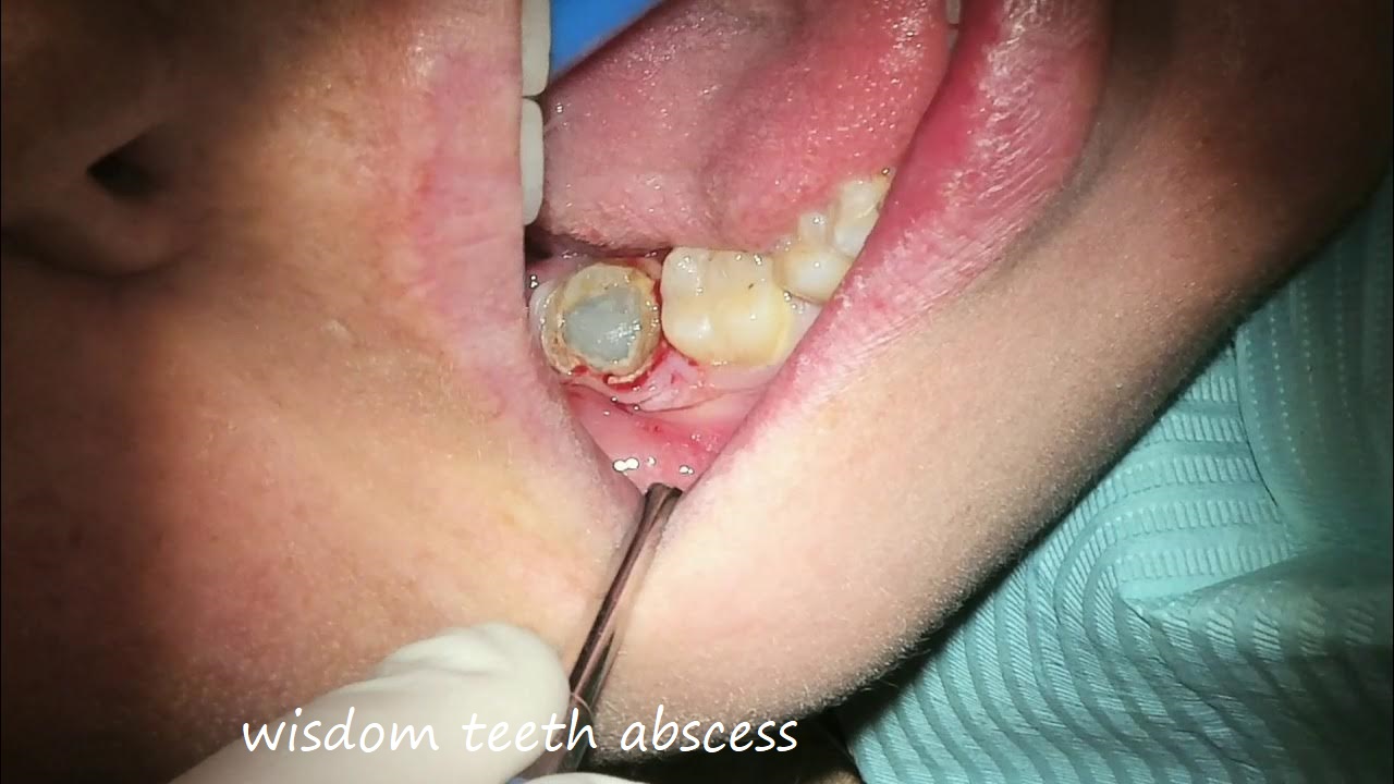 wisdom teeth abscess