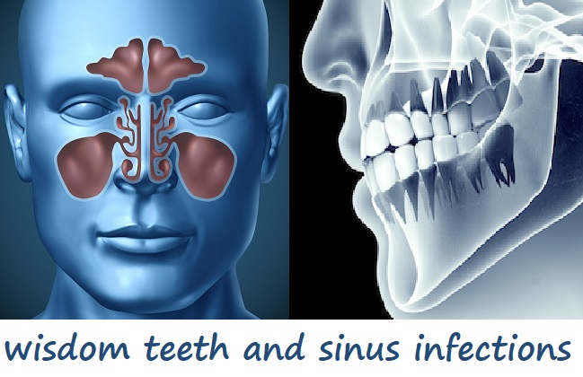 wisdom teeth and sinus infections