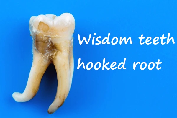 Wisdom teeth hooked root