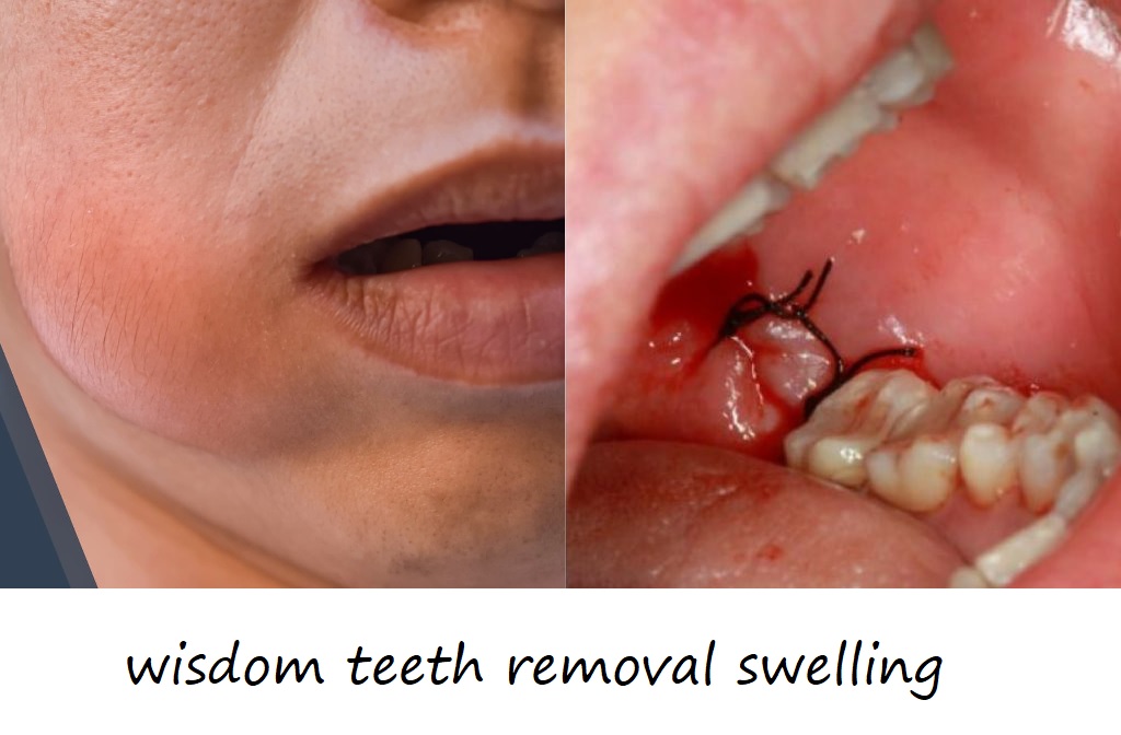 wisdom teeth removal swelling