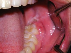 wisdom tooth extraction infection