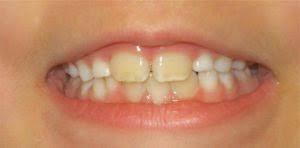 yellow plaque on toddler teeth