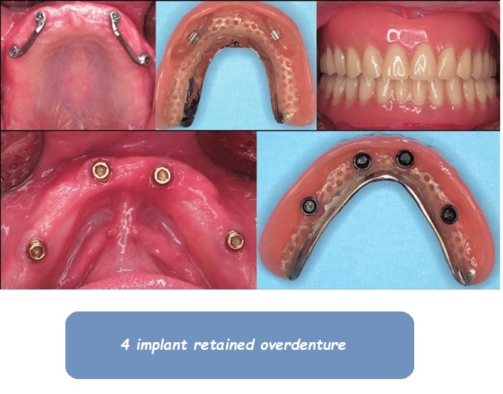 4 implant retained overdenture