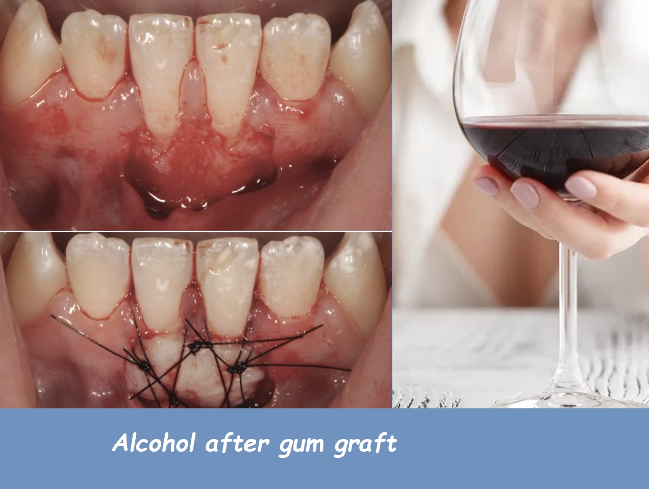 Alcohol after gum graft