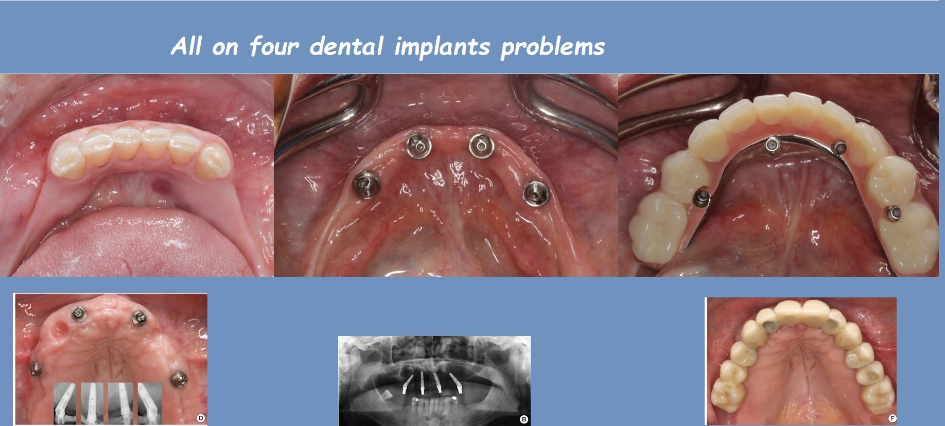 All on four dental implants problems