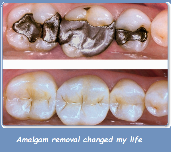 Amalgam removal changed my life