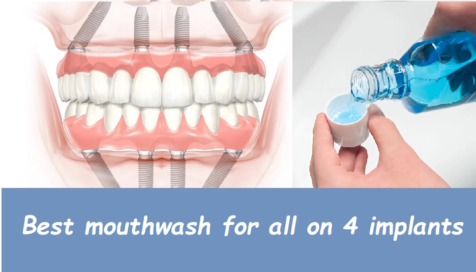 Best mouthwash for All on 4 implants