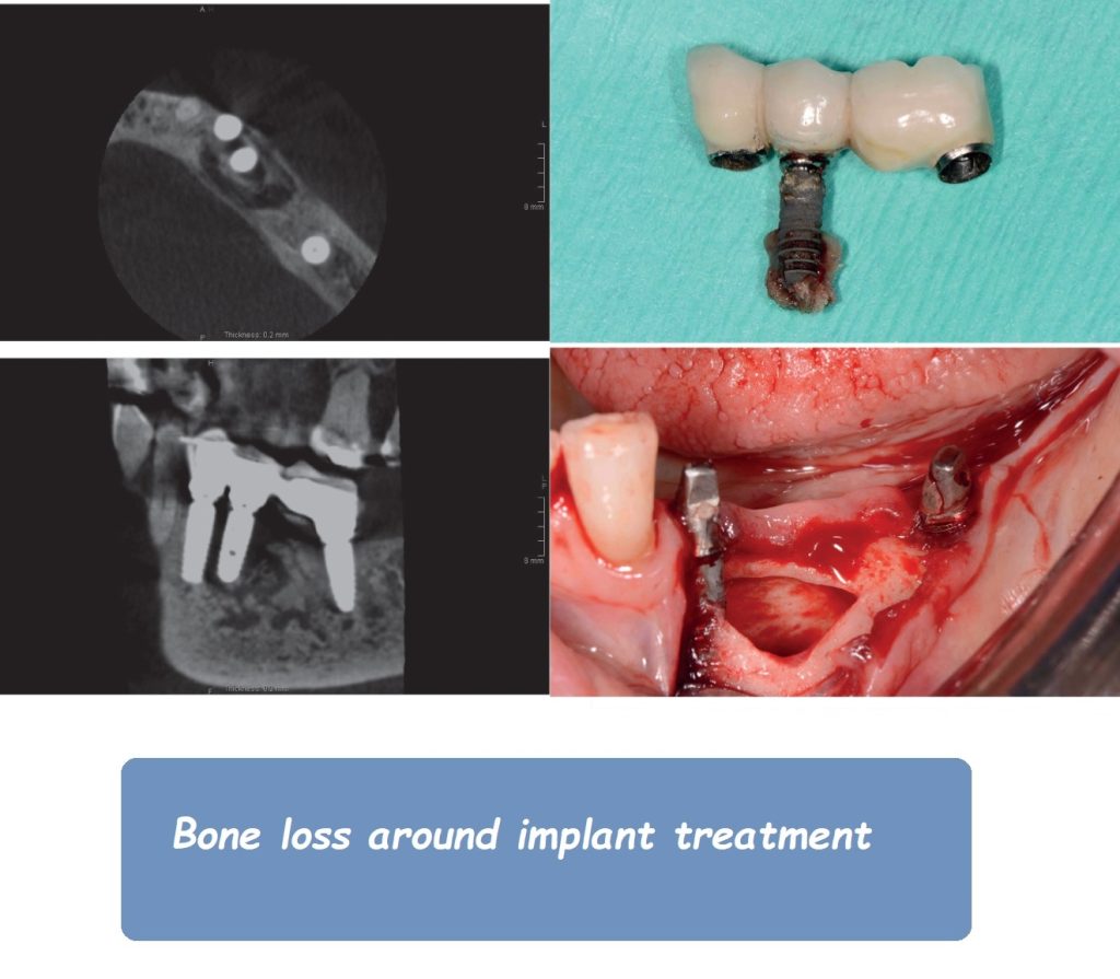 Bone loss around implant treatment