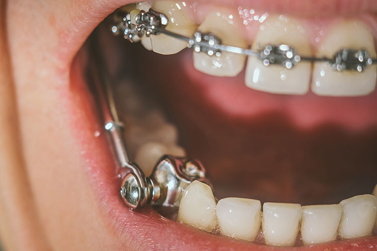 Braces springs for overbite