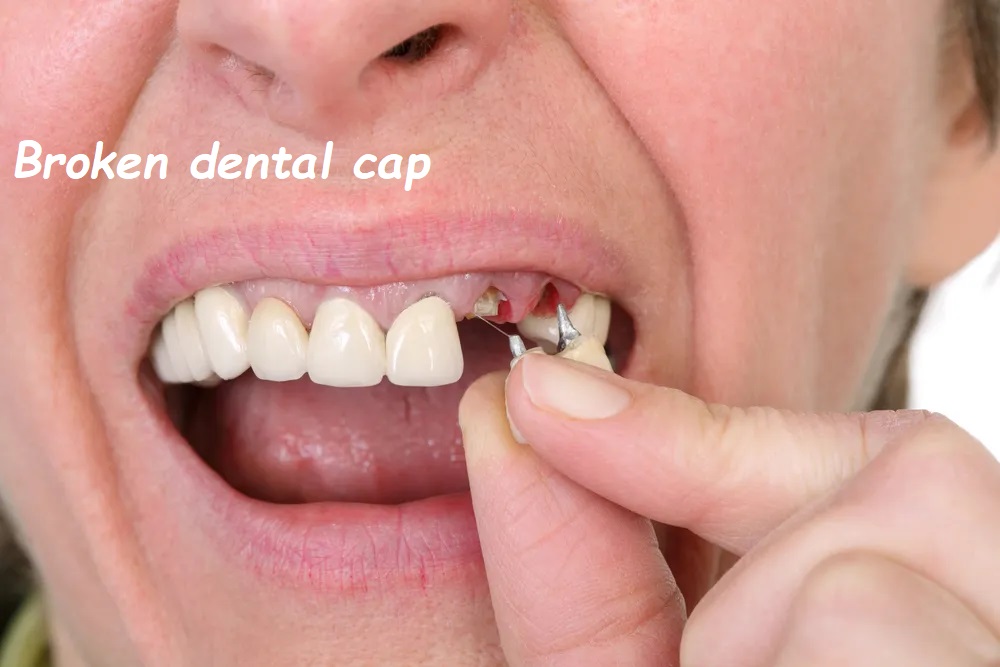 Broken dental cap