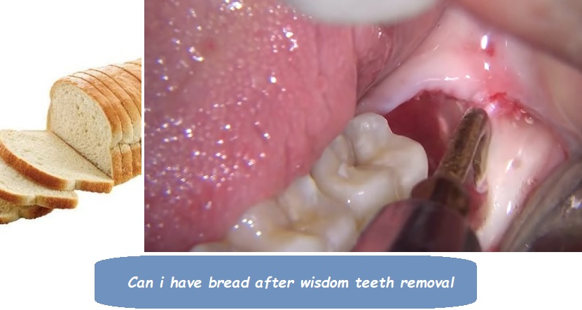 Can i have bread after wisdom teeth removal