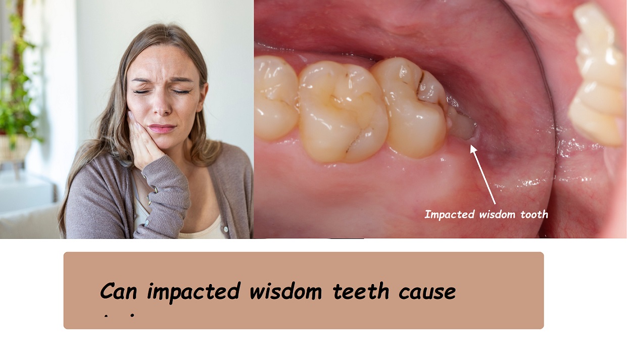 Can impacted wisdom teeth cause tmj