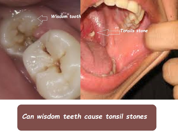 Can wisdom teeth cause tonsil stones