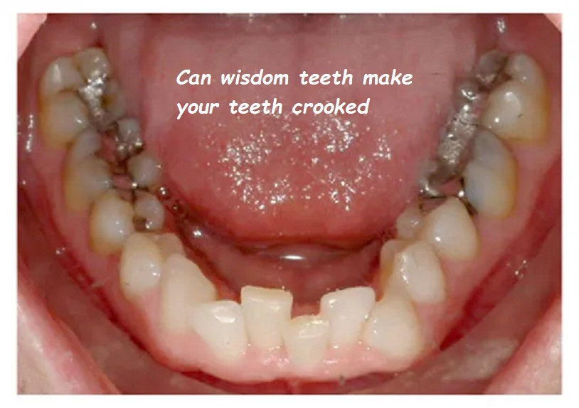 Can wisdom teeth make your teeth crooked