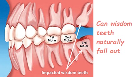 Can wisdom teeth naturally fall out