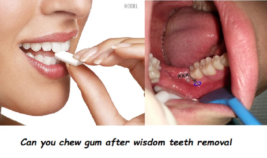 Can you chew gum after wisdom teeth removal