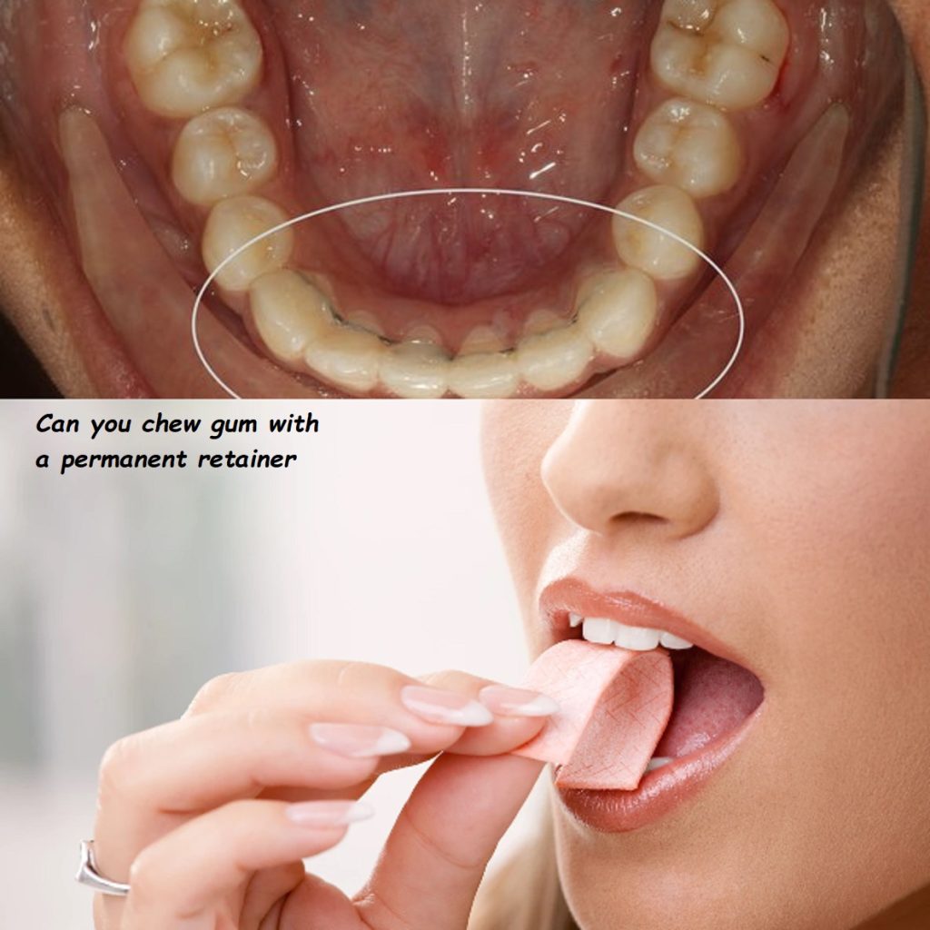 Can you chew gum with a permanent retainer