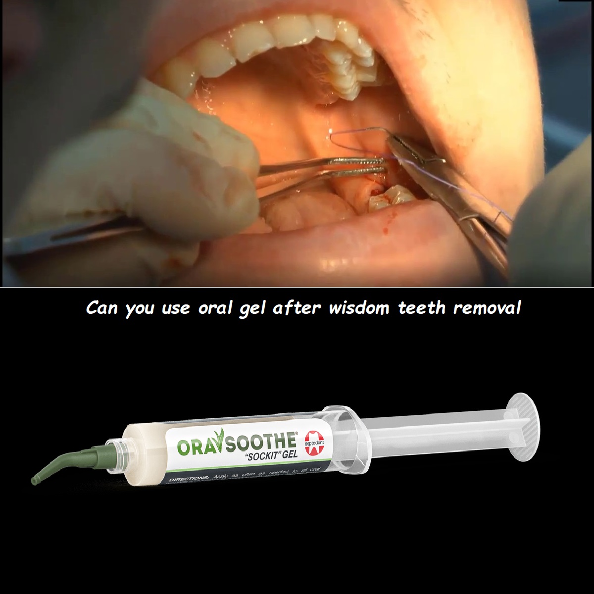 Can you use oral gel after wisdom teeth removal