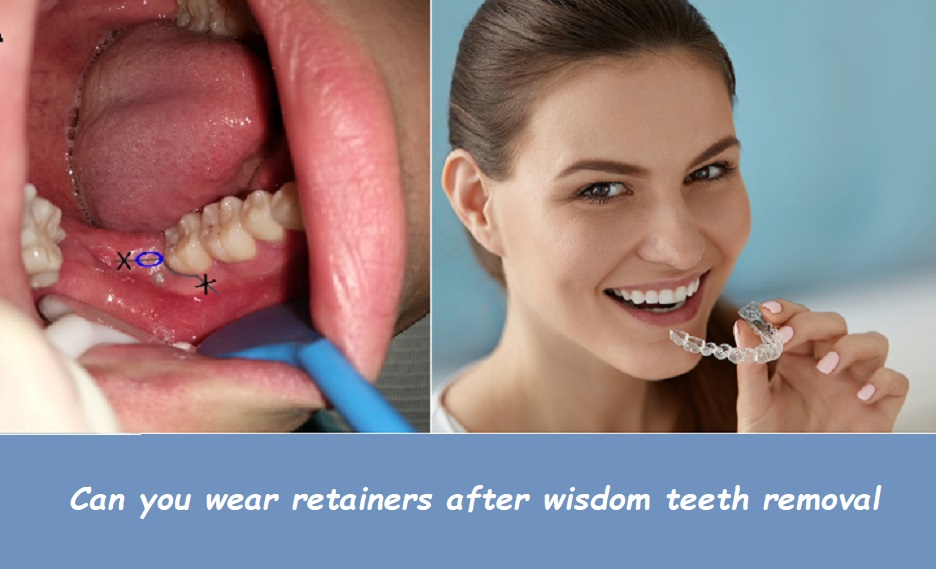 Can you wear retainers after wisdom teeth removal