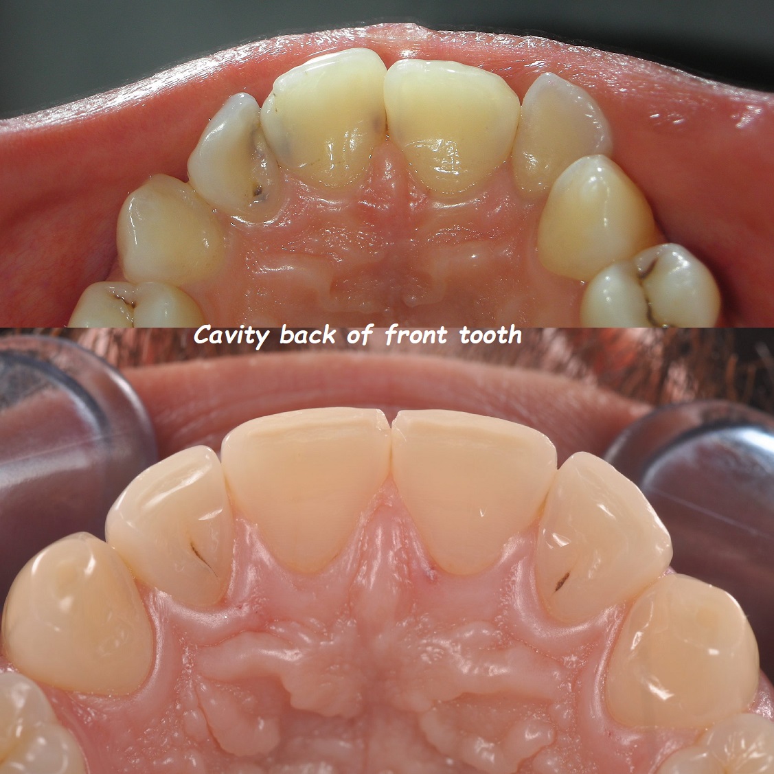 Cavity back of front tooth