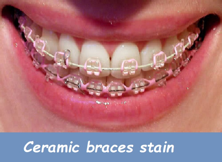 Ceramic braces stain