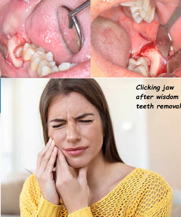 Clicking jaw after wisdom teeth removal