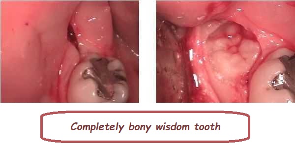 Completely bony wisdom tooth