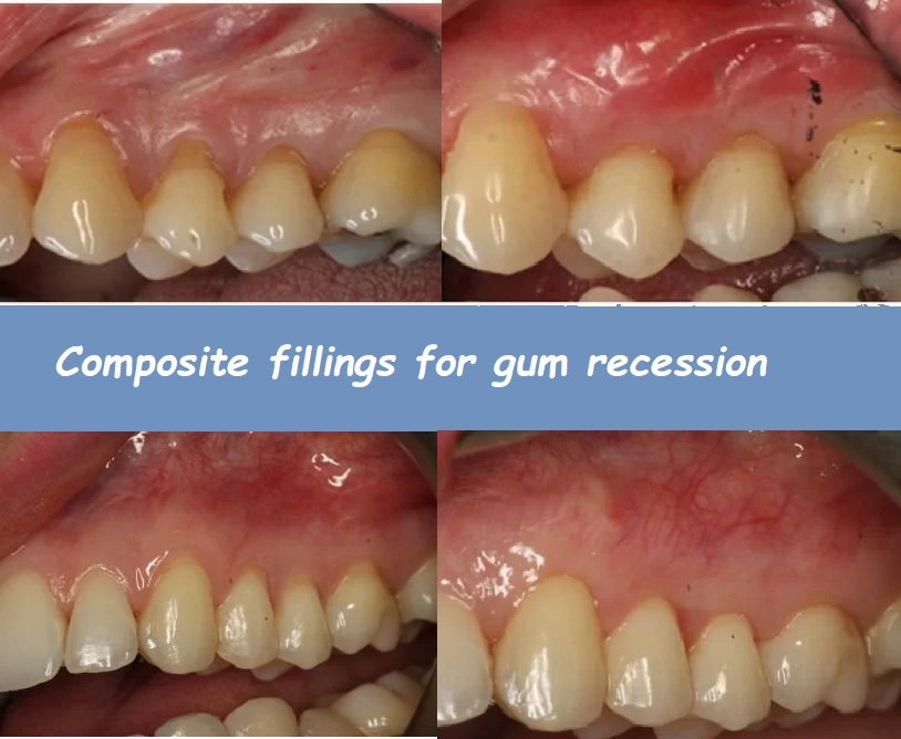 Composite fillings for gum recession