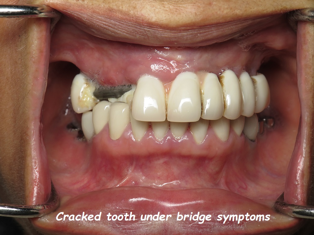 Cracked tooth under bridge symptoms