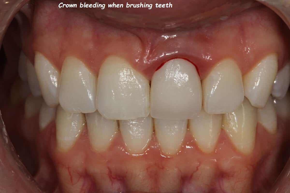 Crown bleeding when brushing teeth