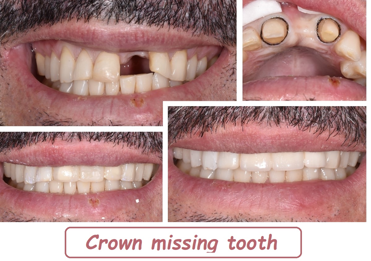 Crown missing tooth