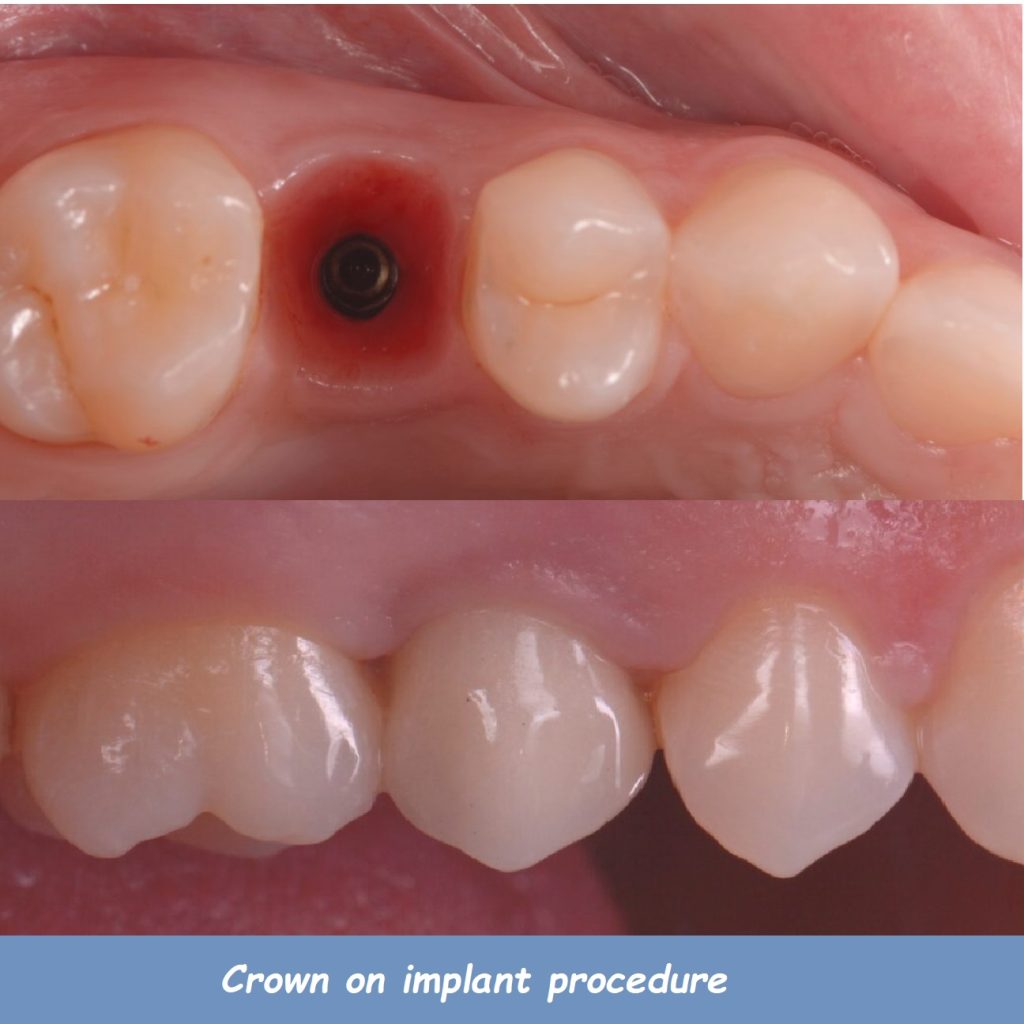 Crown on implant procedure