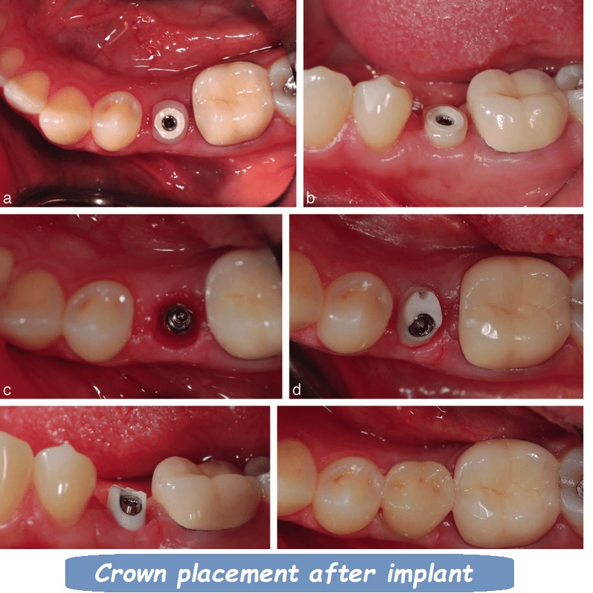 Crown placement after implant