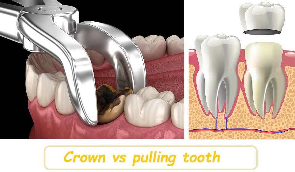 Crown vs pulling tooth