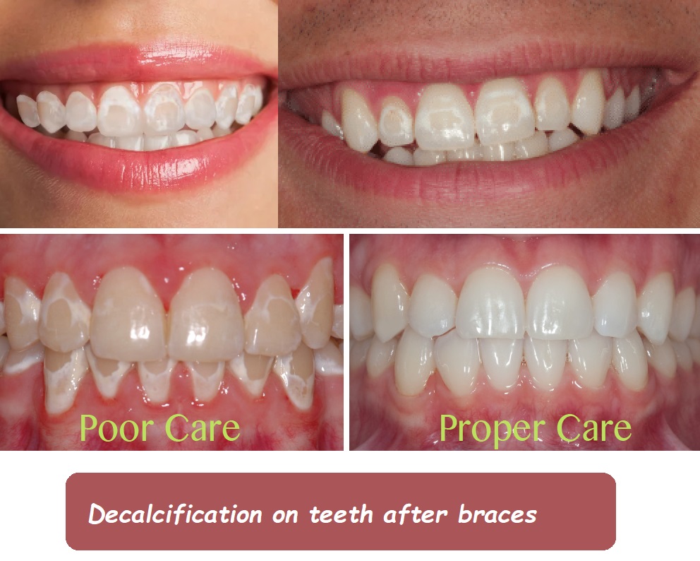 Decalcification on teeth after braces