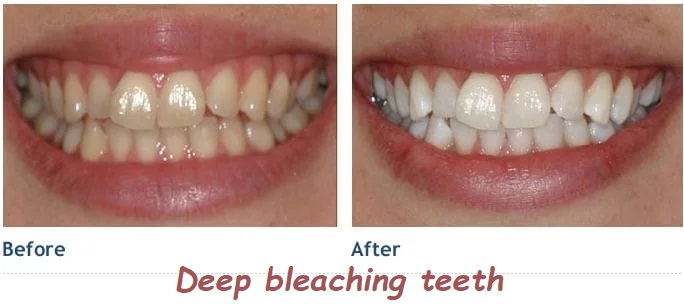 Deep bleaching teeth