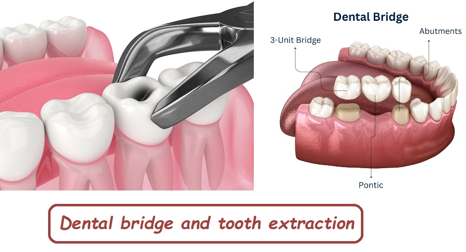 Dental bridge after tooth extraction