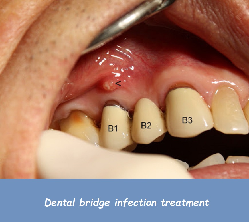 Dental bridge infection