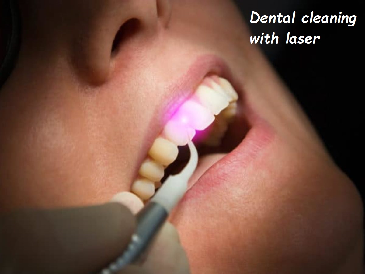 Dental cleaning with laser