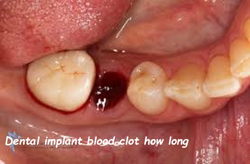 Dental implant blood clot how long