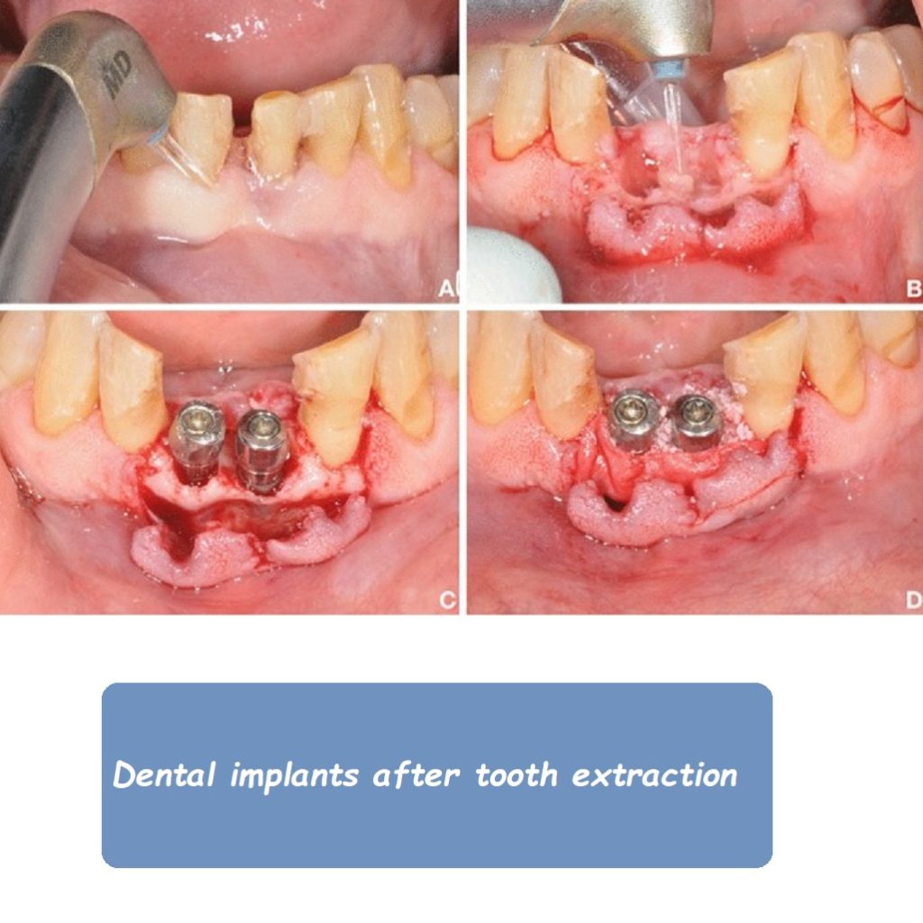 Dental implants after tooth extraction